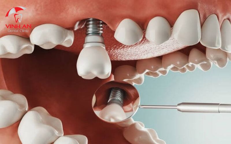 Răng Implant bị lung lay không ổn định