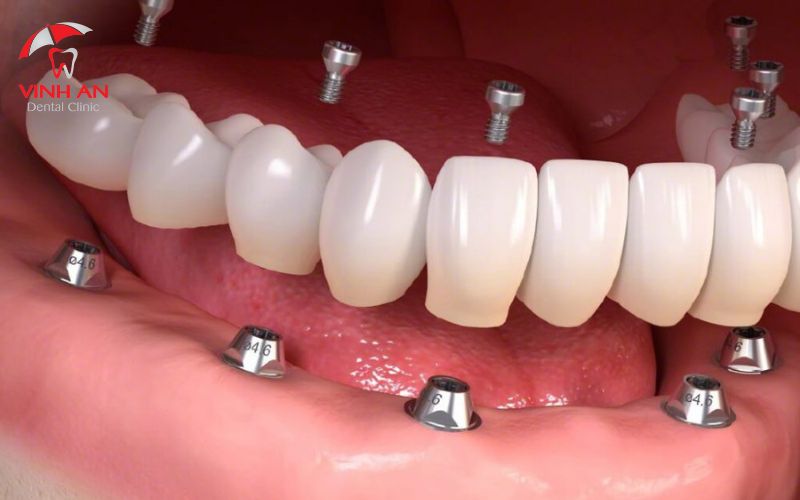 trồng răng Implant an toàn 