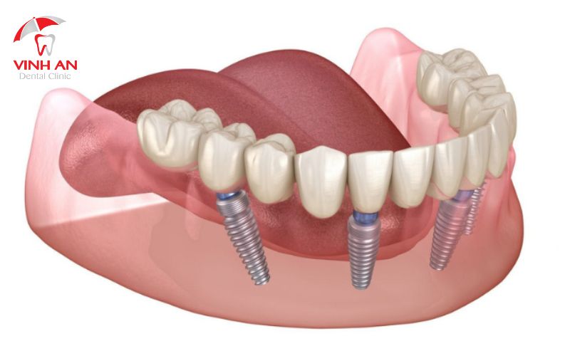 Hướng dẫn chăm sóc răng miệng sau khi cấy ghép răng Implant