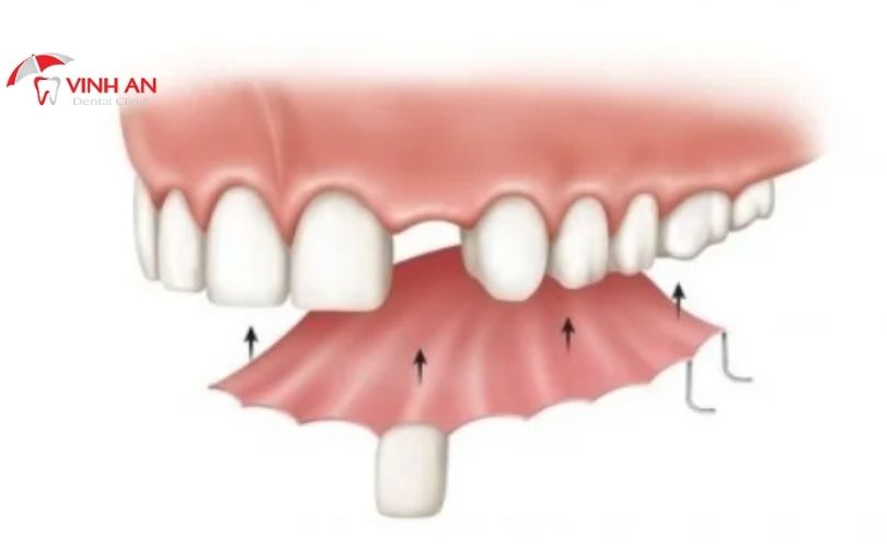 trồng răng cửa implant