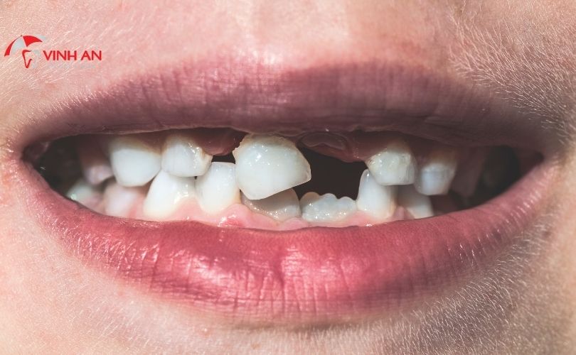 trồng răng cửa implant