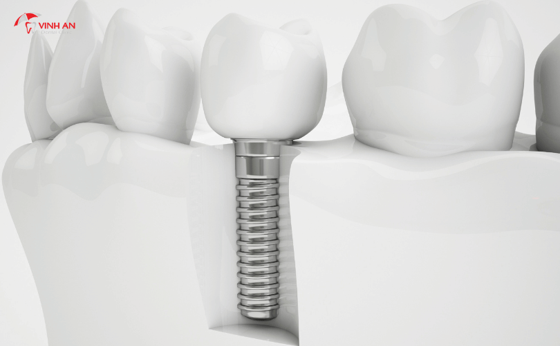 trồng răng implant bao lâu thì ăn được