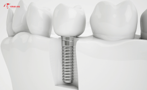 Trồng răng Implant bao lâu thì ăn được