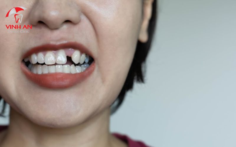 Tiêu xương răng hàm