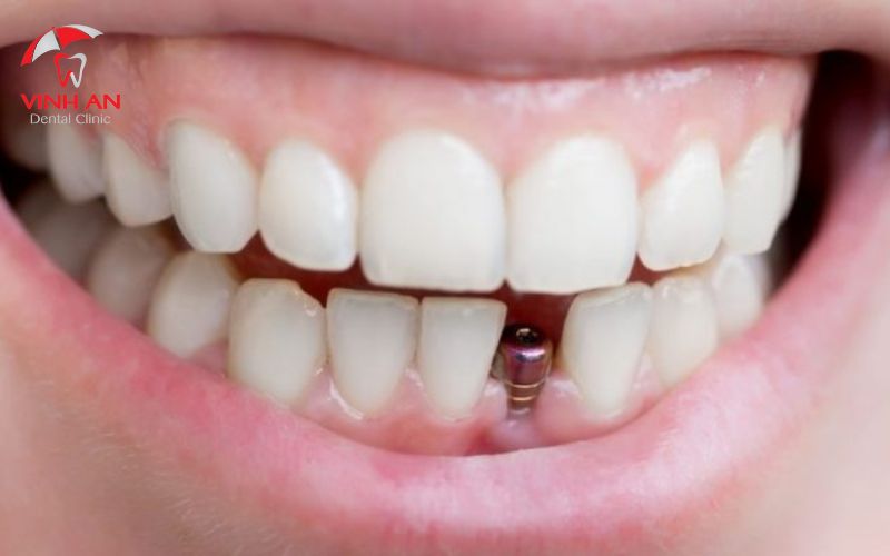 Trường hợp xương có thể đảm bảo để trồng răng implant