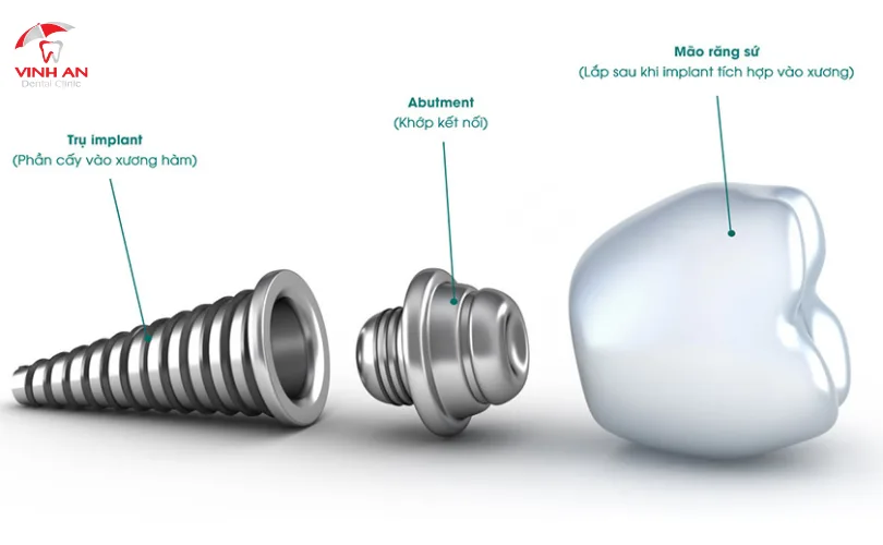 Phương Pháp Implant, Đem Lại Khả Năng Ăn Nhai Giống Như Răng Thật