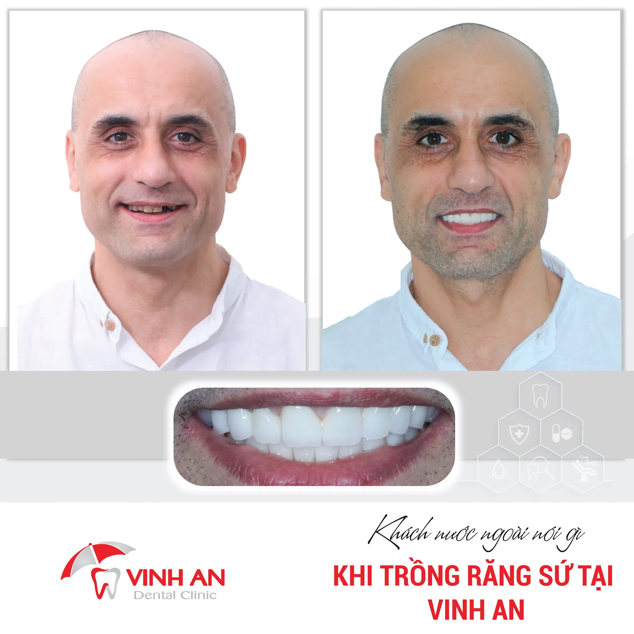 Trồng răng sứ không có chân răng