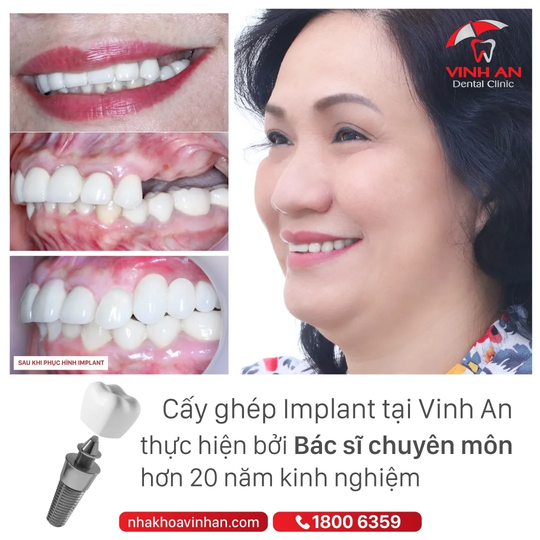 trồng răng sứ không có chân răng