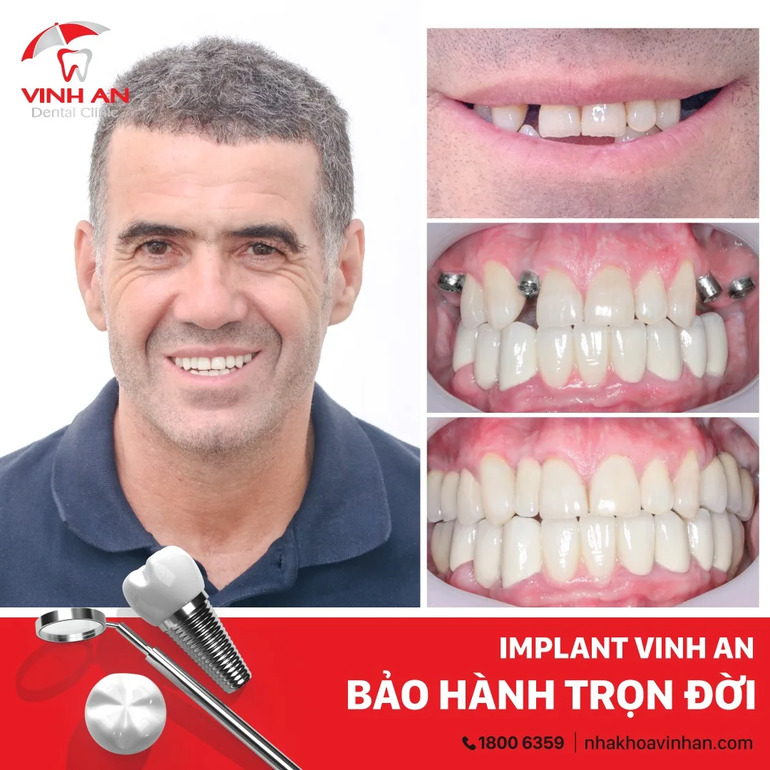 trồng răng sứ không có chân răng