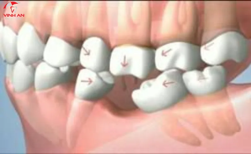 Những vị trí mất chân răng gây ảnh hưởng nghiêm trọng đến sức khỏe