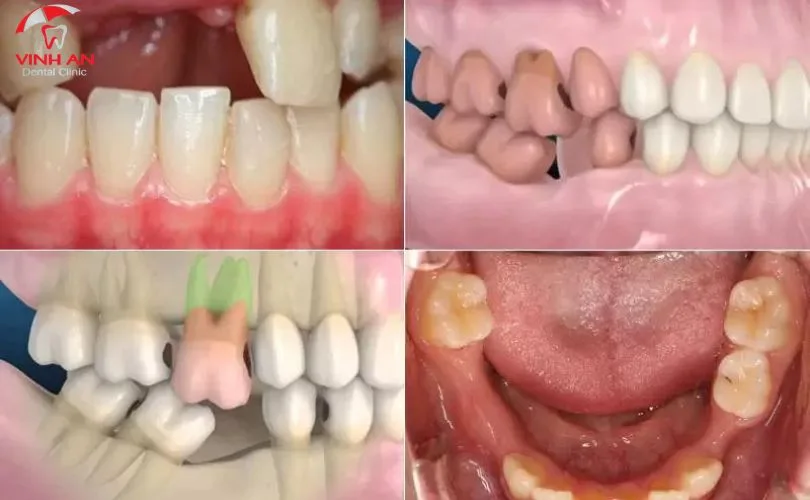 Trồng răng sứ không có chân răng
