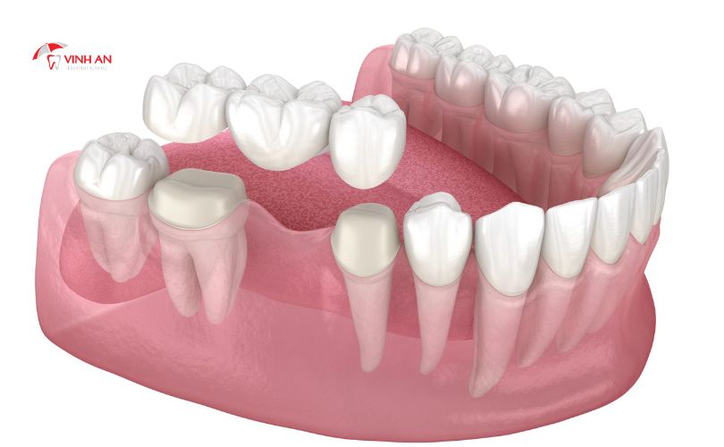 răng bọc sứ có bền không, răng sứ thường có bền không, làm răng sứ có nên không, bọc răng sứ có tốt không, có nên làm răng sứ không, bọc răng sứ thẩm mỹ có bền không, Bọc Răng Sứ Có Bền Không