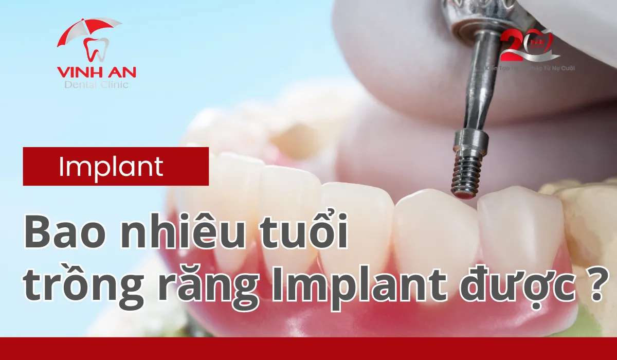 Bao Nhiêu Tuổi Trồng Răng Implant được