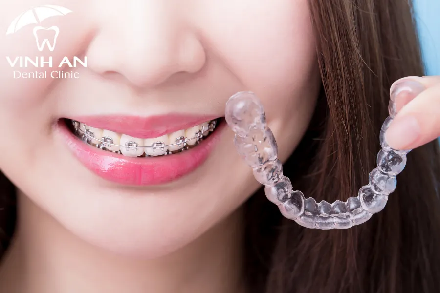 Chỉnh nha góp phần ngăn ngừa các vấn đề về răng miệng và giảm nguy cơ mắc các bệnh lý
