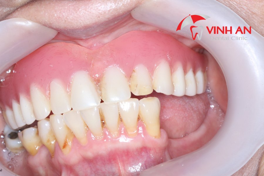 Mất Răng Lâu Năm Có Thể Trồng Được Implant Không 2