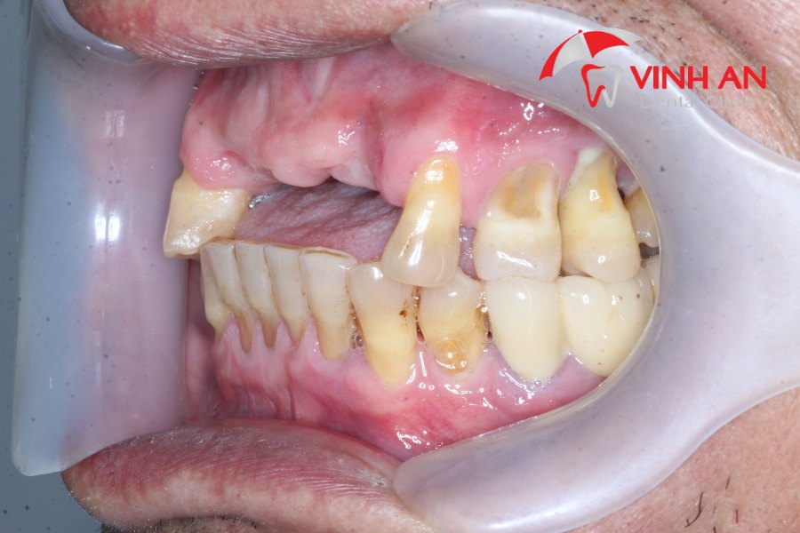 Mất Răng Lâu Năm Có Thể Trồng Được Implant Không 3