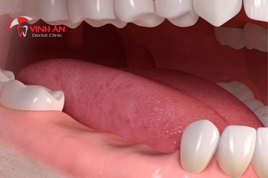 Mất Răng Lâu Năm Có Thể Trồng được Implant Không