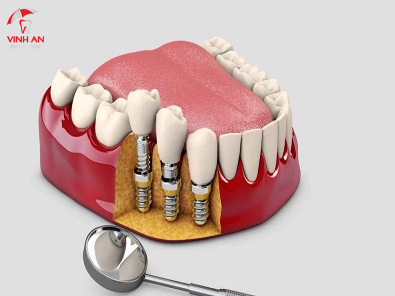 Mất Răng Lâu Năm Có Thể Trồng được Implant Không