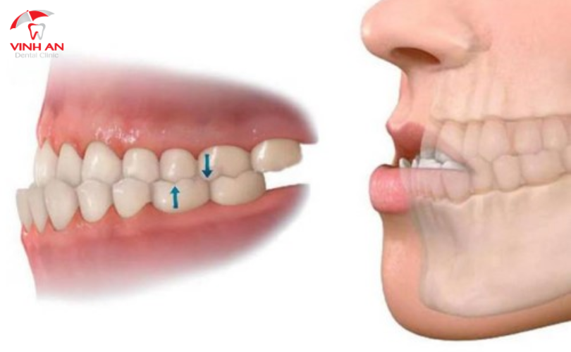 Mất Răng Lâu Năm Có Thể Trồng được Implant Không