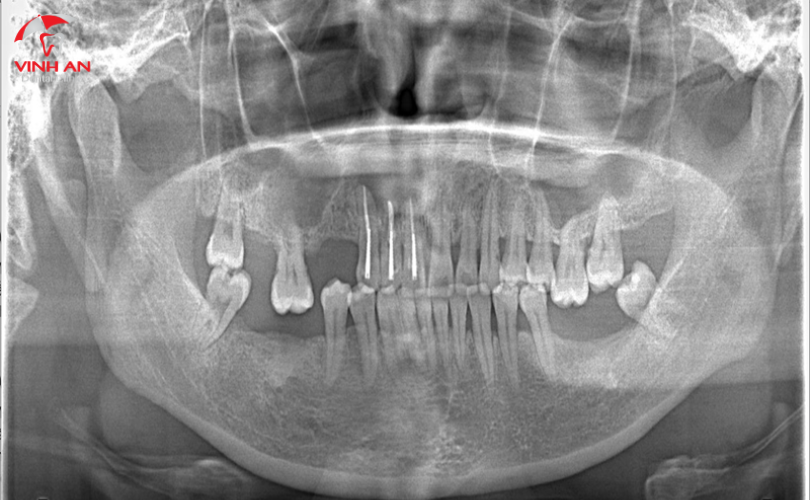 Mất Răng Lâu Năm Có Thể Trồng được Implant Không