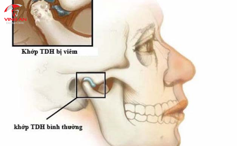 Mất Răng Lâu Năm Có Thể Trồng được Implant Không