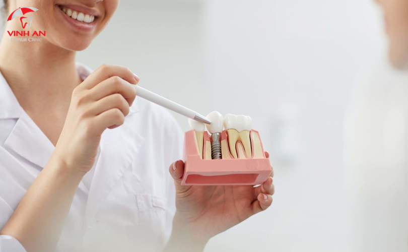 Mất Răng Lâu Năm Có Thể Trồng được Implant Không
