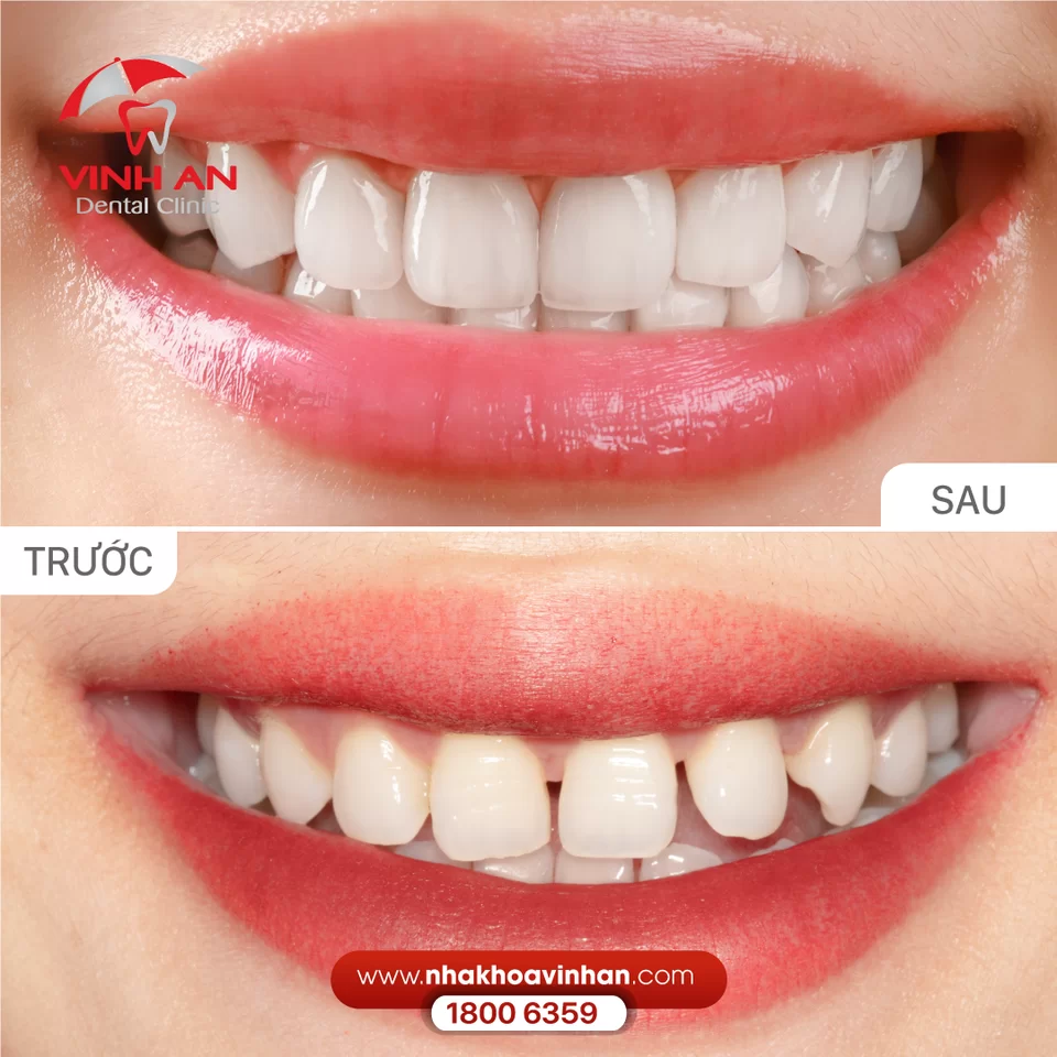 Tháo Răng Sứ Có đau Không