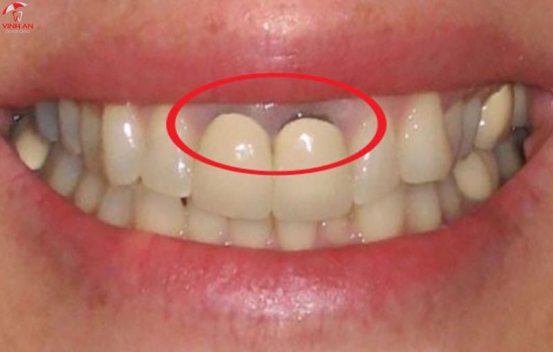 bảng màu răng sứ Zirconia 