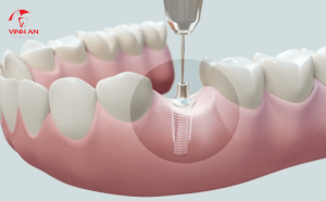 Răng Sứ Implant Có Mắc Không? Quy Trình Và Bảng Gía Chi Tiết