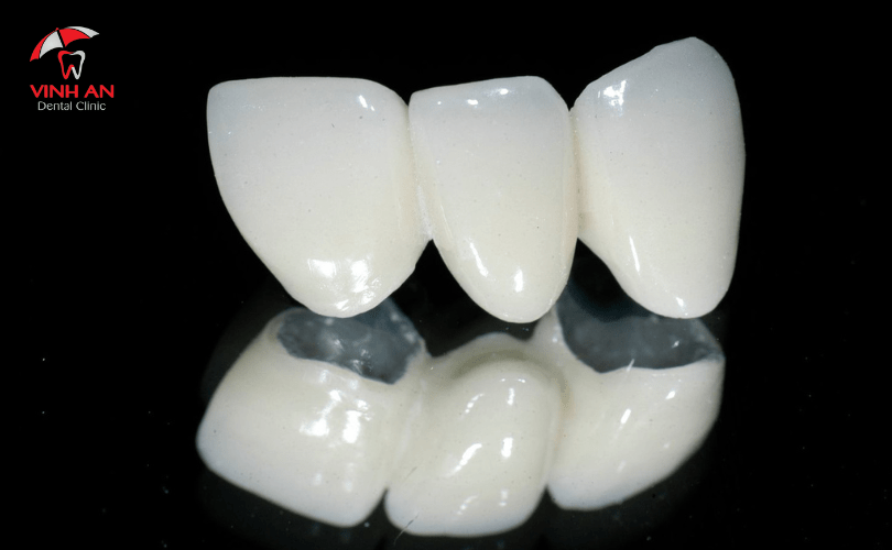 Răng sứ Titan là gì? Những trường hợp nên bọc răng sứ Titan?
