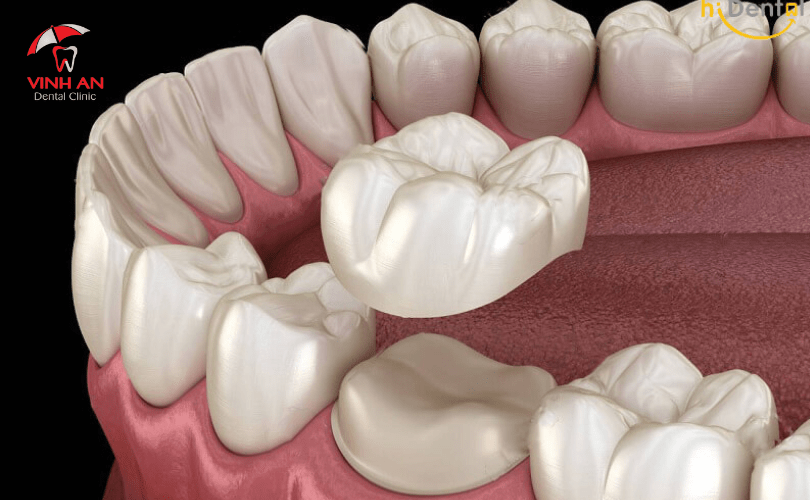 Phương pháp bọc răng sứ Titan