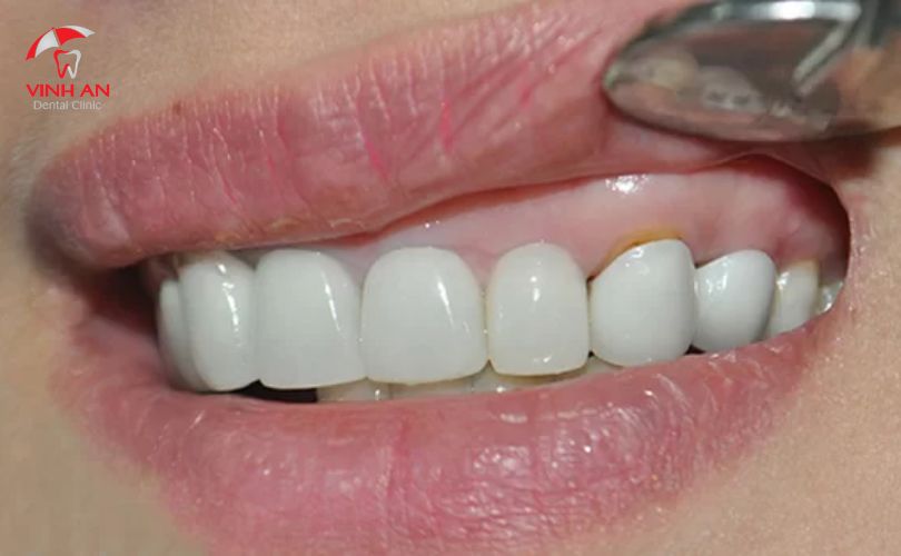 Tháo răng sứ có đau không?