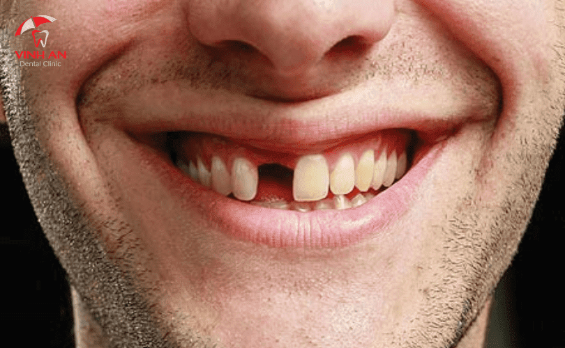 Đối tượng nào có thể làm răng sứ Implant