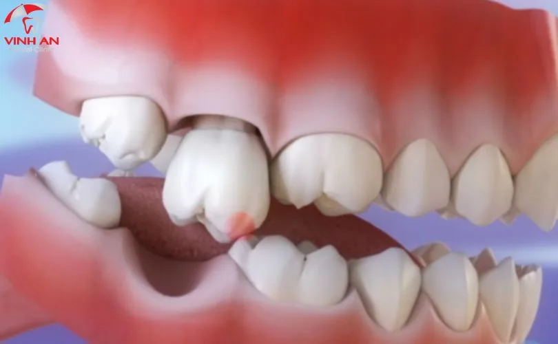 trồng răng sứ không có chân răng