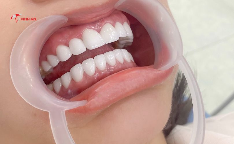 răng bọc sứ có bền không, răng sứ thường có bền không, làm răng sứ có nên không, bọc răng sứ có tốt không, có nên làm răng sứ không, bọc răng sứ thẩm mỹ có bền không, Bọc Răng Sứ Có Bền Không