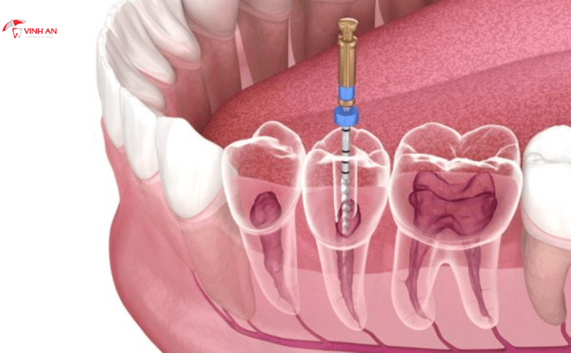 Quy Trình Điều Trị Khi Bọc Răng Sứ Bị Viêm Tủy