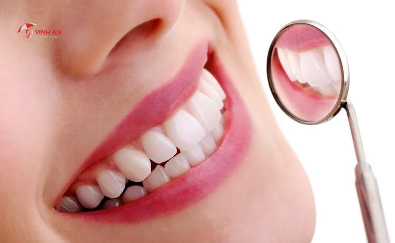 răng sứ lava plus, răng sứ lava plus giá bao nhiêu, chất lượng răng sứ lava plus, bọc răng sứ lava, Răng Sứ Lava