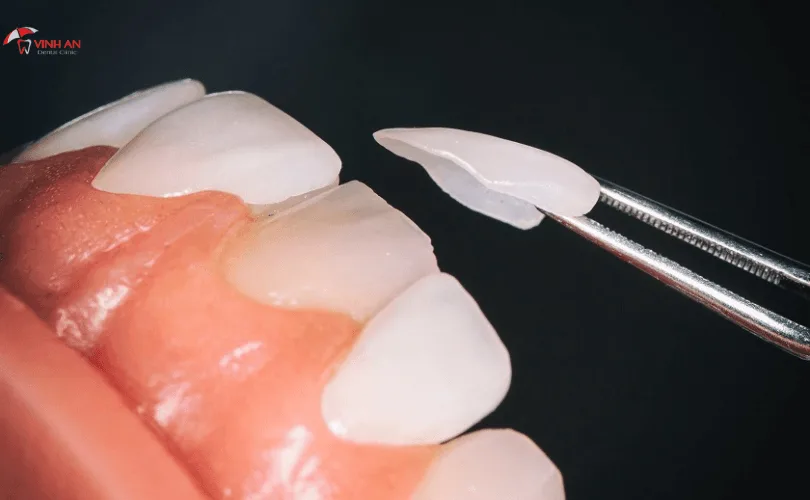 Răng Sứ LISI Là Gì? Xuất Xứ Từ Đâu?