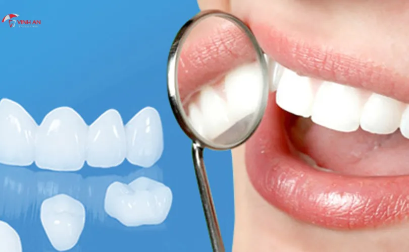 Răng Sứ LISI Có Tốt Không?