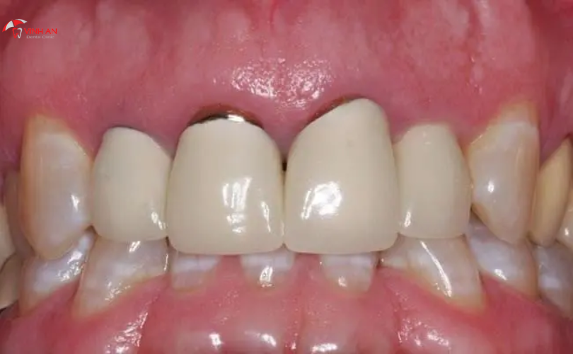 Bọc răng sứ Titan có tác hại gì không? Răng sứ Titan có bị đen không?
