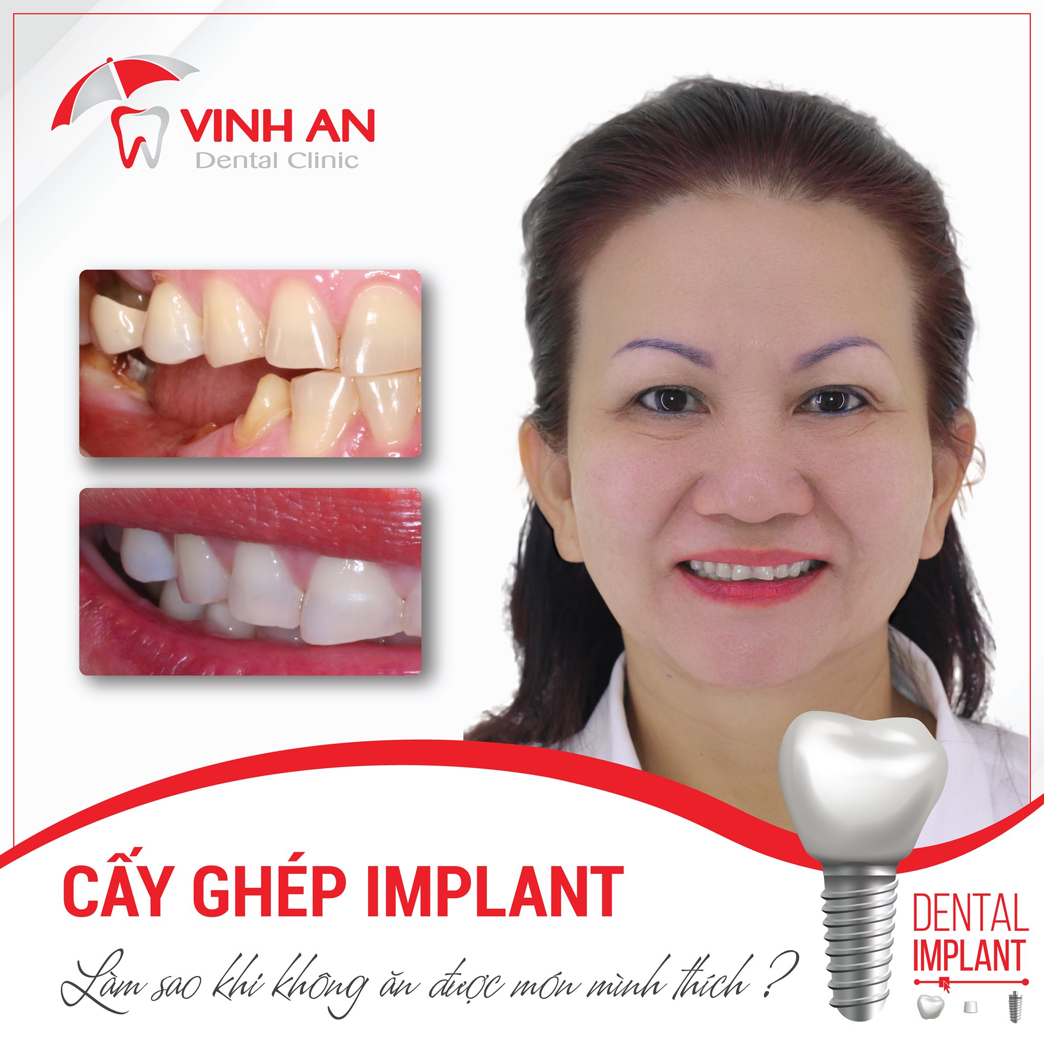 trồng răng khểnh Implanttrồng răng khểnh Implant