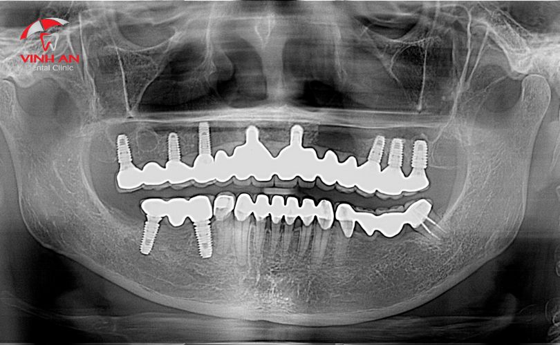 trồng răng implant loại nào tốt