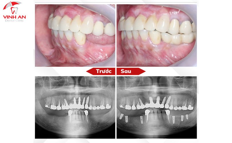 trồng răng khểnh Implant