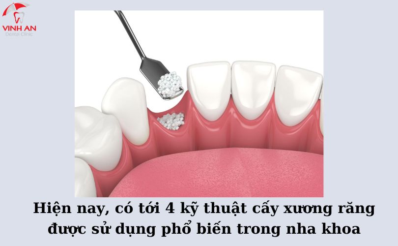 Ghép xương hàm
