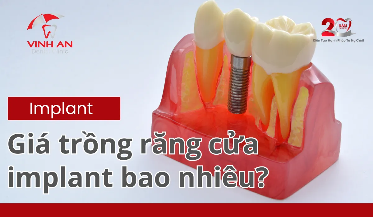 Giá Trồng Răng Cửa Bao Nhiêu