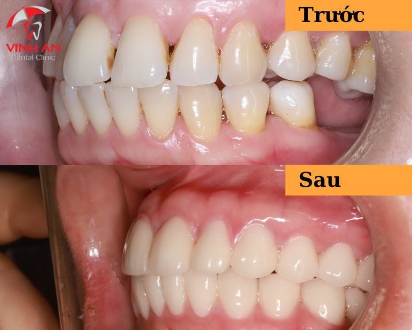 Hình ảnh Trước Và Sau Khi Trồng Răng Implant Của Chị Thùy Trinh