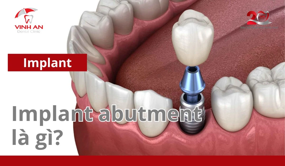 Implant Abutment