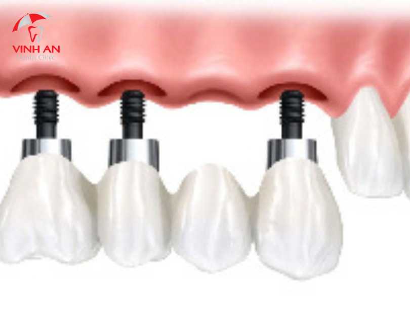 Implant Thay Thế 1 Răng