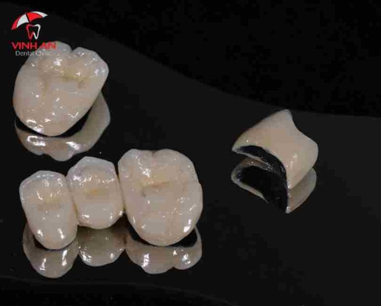 Implant Thay Thế 1 Răng Là Gì ? Quy Trình Và Chi Phí