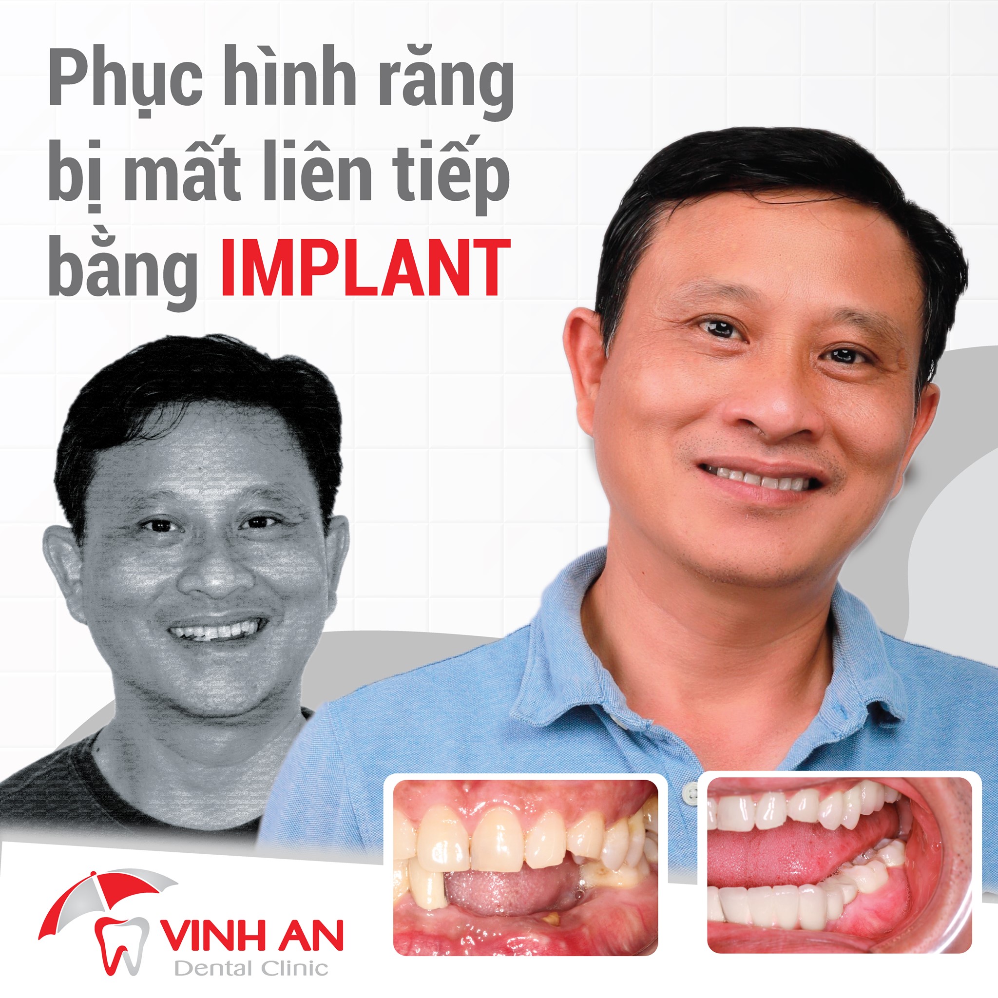 Chia sẻ từ anh Quang khi trồng Implant
